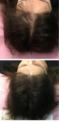 Foto EVA MARIN MICROPIGMENTACI�N CAPILAR