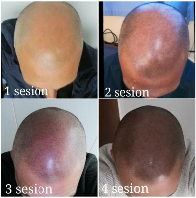 Foto EVA MARIN MICROPIGMENTACI�N CAPILAR