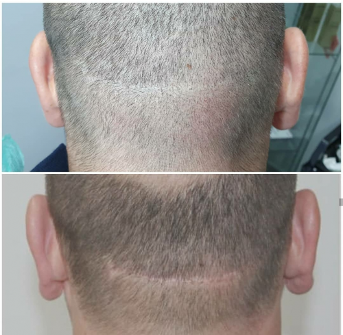 Foto EVA MARIN MICROPIGMENTACI�N CAPILAR