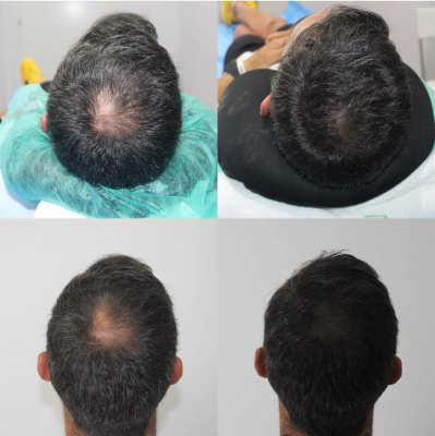 Foto EVA MARIN MICROPIGMENTACI�N CAPILAR