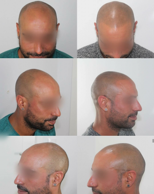 Foto EVA MARIN MICROPIGMENTACI�N CAPILAR