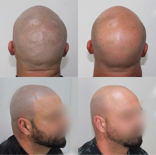 Foto EVA MARIN MICROPIGMENTACI�N CAPILAR