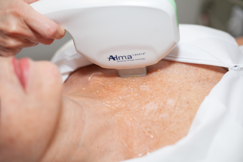 Fotorrejuvenecimiento de escote