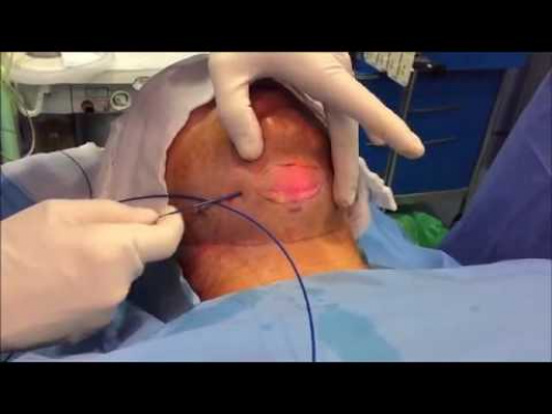Tightening o Retensado de Cuello