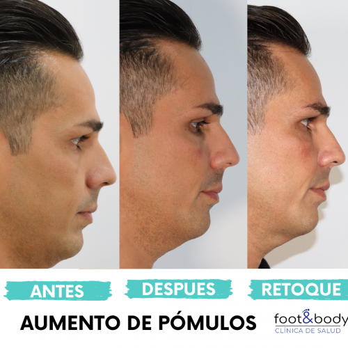 Relleno de p�mulos perfil