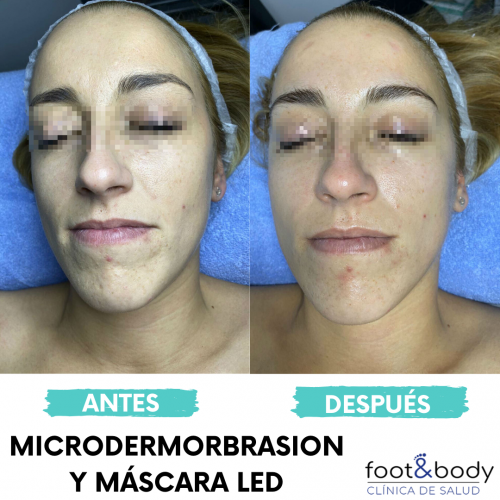 Limpieza facial