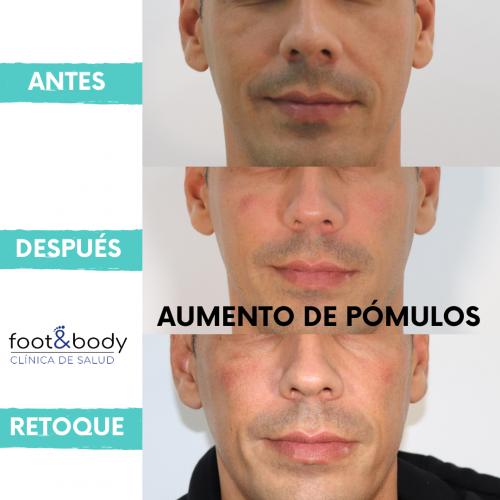 Relleno de p�mulos frontal
