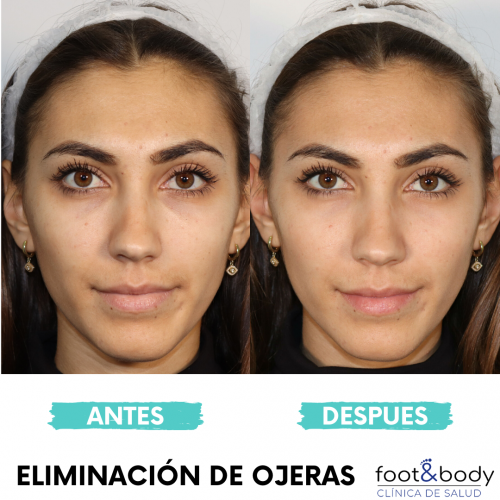Eliminac�on de ojeras