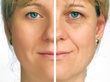 Rejuvenecimiento facial mediante laser lifting