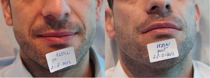 Tratamiento de Radiesse