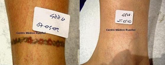 Eliminaci�n de tatuaje con color