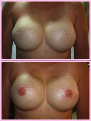 Micropigmentaci�n areolas
