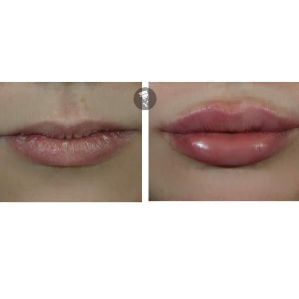 Aumento de Labios 2 viales 500� en TodoEstetica.com