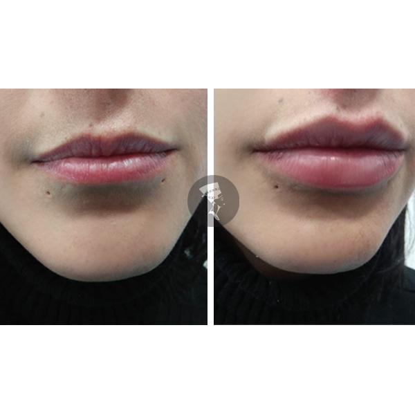 Aumento de Labios 2 viales 500� en TodoEstetica.com