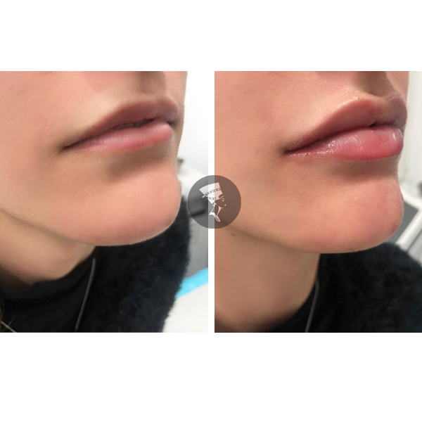 Aumento de Labios 2 viales 500� en TodoEstetica.com