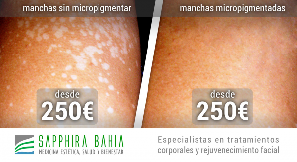 Micropigmentacin mdica Capilar - Cejas - Labios - Linea del ojo - Areola Mamaria - Vitligo - Cicatrices - Desde 250 en TodoEstetica.com
