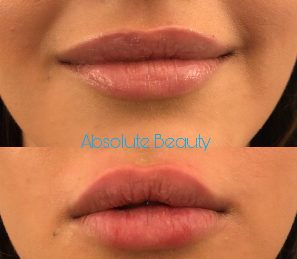 SI ERES DE CORDOBA ESTA OFERTA TE INTERESA: AUMENTO DE LABIO en TodoEstetica.com
