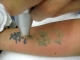 Eliminaci�n de tatuajes en TodoEstetica.com