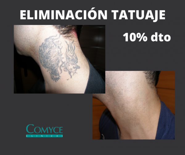 ELIMINACIN DE TATUAJES CON LSER en TodoEstetica.com