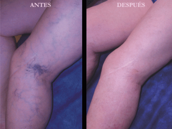 Solución a las varices regenerando las venas en TodoEstetica.com