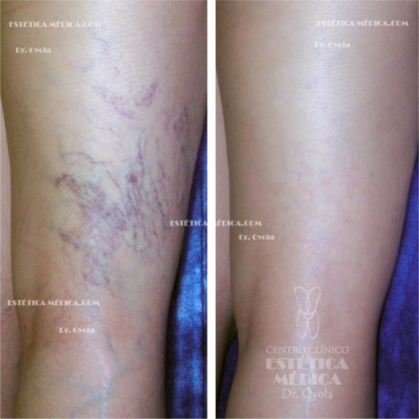 Solución a las varices regenerando las venas en TodoEstetica.com