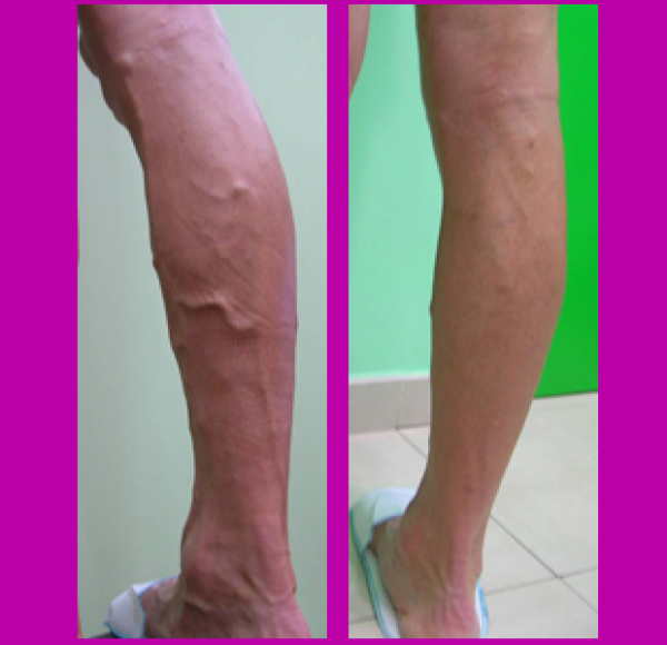 Solución a las varices regenerando las venas en TodoEstetica.com