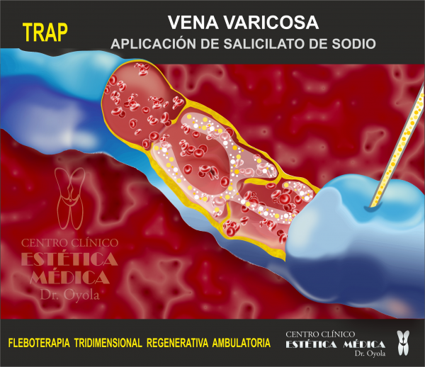 Solución a las varices regenerando las venas en TodoEstetica.com