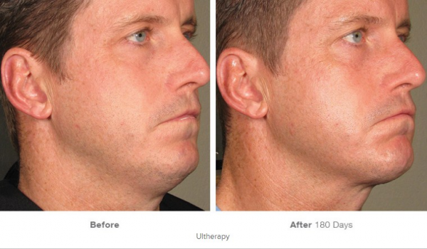 Lifting facial sin cirugia HIFU Ultraterapia en TodoEstetica.com