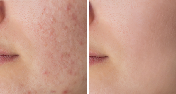 Microdermoabrasi�n a 50 � en Cl�nicas DH Valencia en TodoEstetica.com