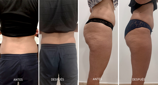 5 sesiones de Mesoterapia Corporal Cl�nicas DH en TodoEstetica.com