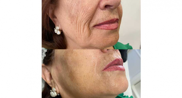 Microdermoabrasión + Radiofrecuencia Facial Antiedad en Clínicas DH Toledo