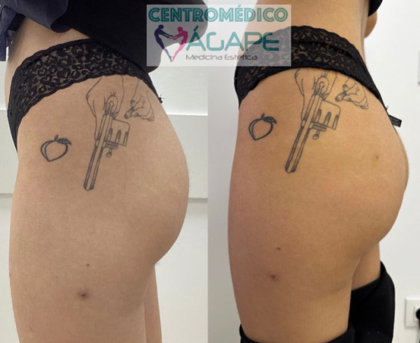 LANLUMA X - 2 VIALES en TodoEstetica.com