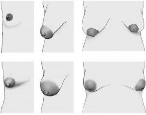 �Qu� es la hipoplasia mamaria o hipomastia? Tipos y soluciones