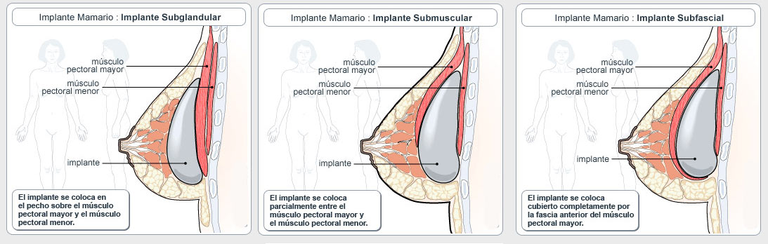 �Es mejor colocar el implante delante o detr�s del pectoral?