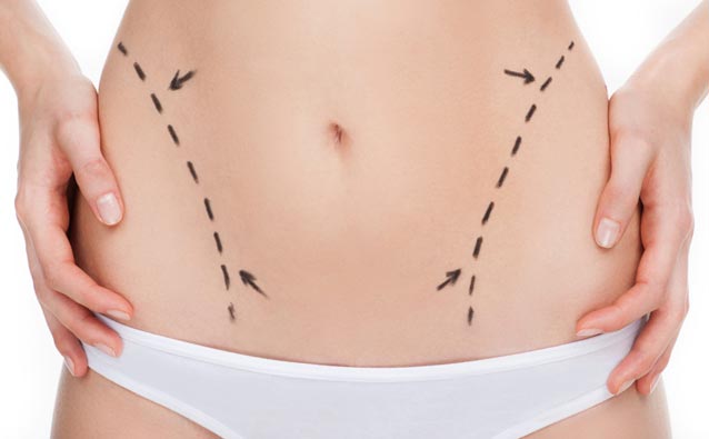 Liposucci�n de caderas. Guia del proceso