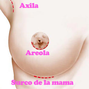 Vias de introducci�n: �areola, axila o surco mamario?