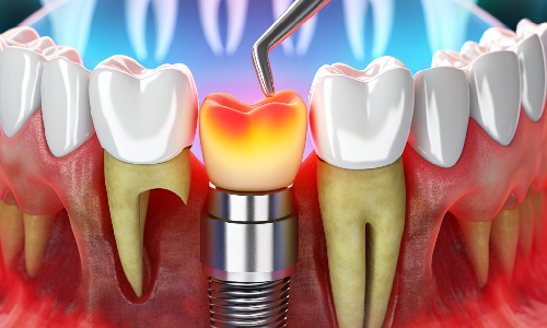 Nueva técnica de implantología revoluciona el tratamiento del desdentamiento mandibular anterior