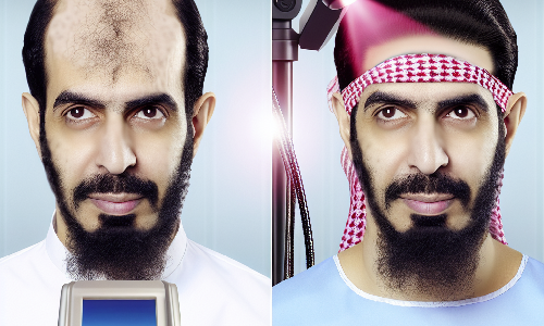 Avance Significativo en Tratamientos de Alopecia: El Láser de Dióxido de Carbono Promueve la Regeneración Capilar