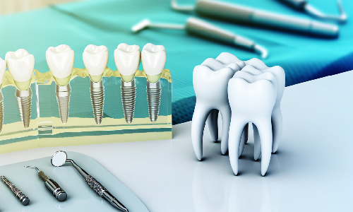 Avances en Implantes Dentales: Guía Completa de Weare Family Dentistry