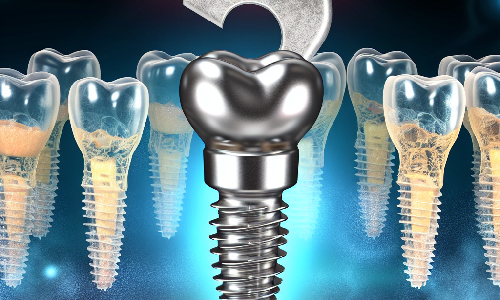 Innovadora tcnica de implantes inmediatos en zona esttica dental revoluciona la Implantologa