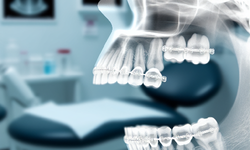 Estudio revela la eficacia de alineadores transparentes en cirugas maxilares complejas