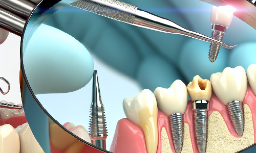 Avances en la colocacin inmediata de implantes dentales tras extracciones con patologa apical
