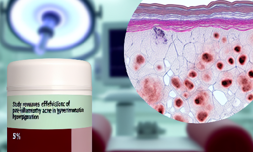 Estudio Revela Efectividad de Crema de Cisteamina al 5% en Hiperpigmentacin Post-Inflamatoria Acnica