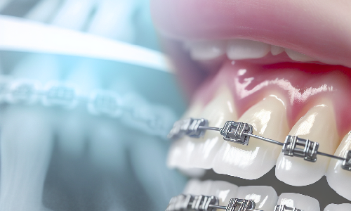 Revelador Estudio en el Dentistry Journal Destaca la Conexin Entre Tratamiento Ortodncico y Salud Periodontal