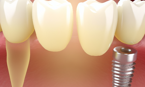 Estudio piloto clnico prospectivo evala un diseo innovador de implantes dentales en la zona esttica